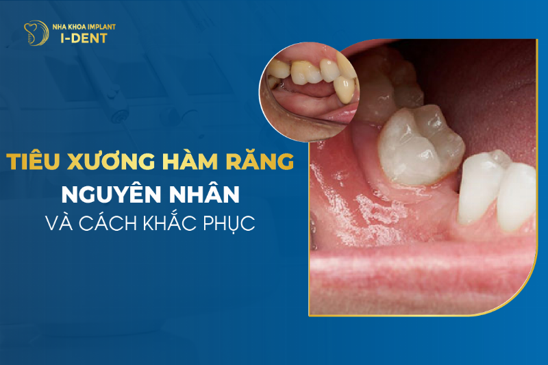 Hình ảnh minh họa quá trình tiêu xương hàm sau khi mất răng số 6